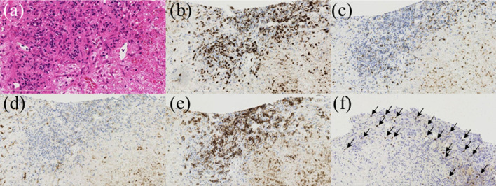 Primary Hepatic Other Iatrogenic Immunodeficiency-Associated Lymphoproliferative Disorders After Methotrexate Therapy.