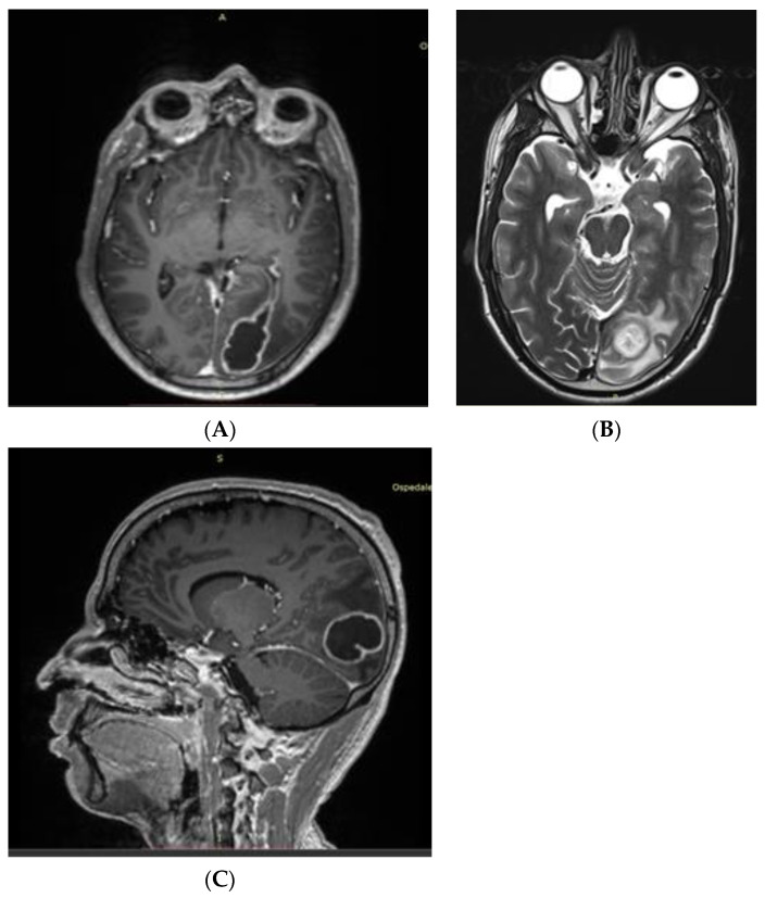 <i>Streptococcus intermedius</i> Brain Abscess with Lung Abscess and Aortic Valve Endocarditis: A Case Report and Literature Review.