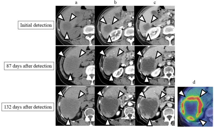 Primary Hepatic Other Iatrogenic Immunodeficiency-Associated Lymphoproliferative Disorders After Methotrexate Therapy.