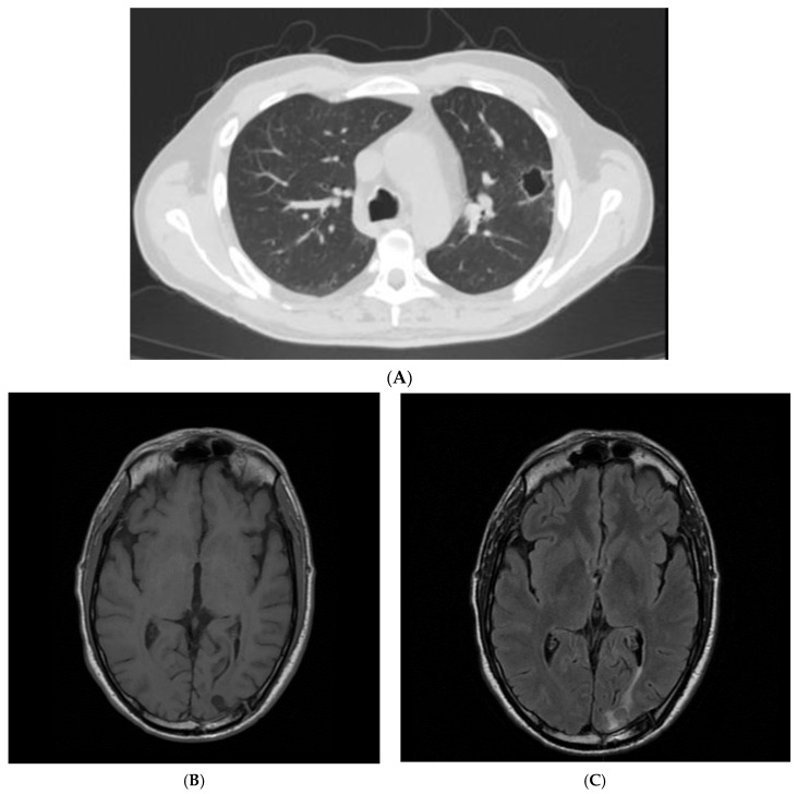 <i>Streptococcus intermedius</i> Brain Abscess with Lung Abscess and Aortic Valve Endocarditis: A Case Report and Literature Review.