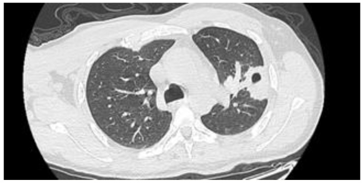 <i>Streptococcus intermedius</i> Brain Abscess with Lung Abscess and Aortic Valve Endocarditis: A Case Report and Literature Review.