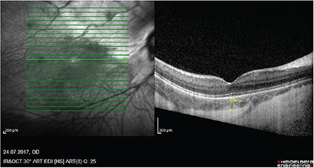 Macular Imaging Characteristics in Children with Myelinated Retinal Nerve Fiber and High Myopia Syndrome.