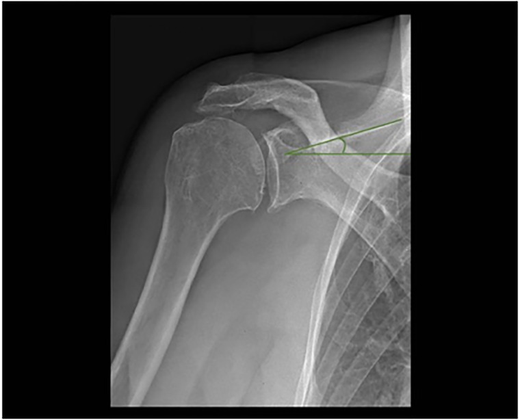 Surgical Approach for RSA has Little or no Influence on Scapular Inclination and Glenoid Baseplate Tilt Relative to the Horizontal.