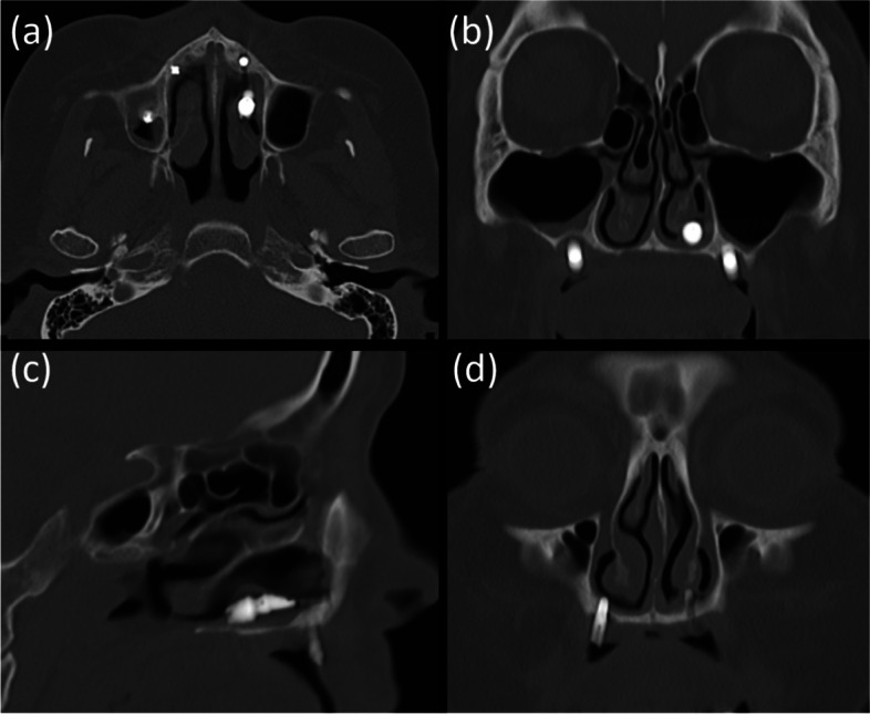 Nasal cavity perforation by implant fixtures: case series with emphasis on panoramic imaging of nasal cavity extending posteriorly.