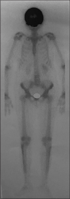 A rare case of asymptomatic Paget's disease of the skull in a 60-year-old Asian female.