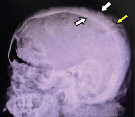 A rare case of asymptomatic Paget's disease of the skull in a 60-year-old Asian female.