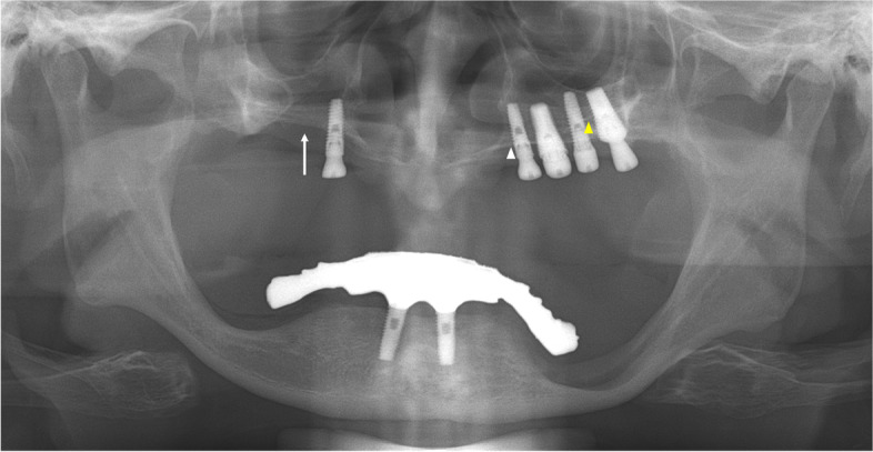 Nasal cavity perforation by implant fixtures: case series with emphasis on panoramic imaging of nasal cavity extending posteriorly.