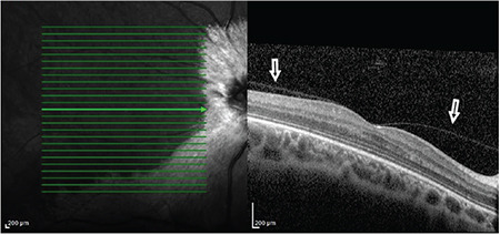 Macular Imaging Characteristics in Children with Myelinated Retinal Nerve Fiber and High Myopia Syndrome.