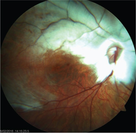 Macular Imaging Characteristics in Children with Myelinated Retinal Nerve Fiber and High Myopia Syndrome.