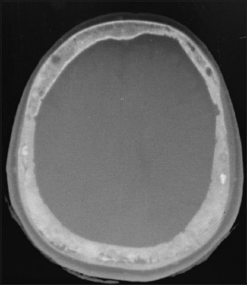A rare case of asymptomatic Paget's disease of the skull in a 60-year-old Asian female.