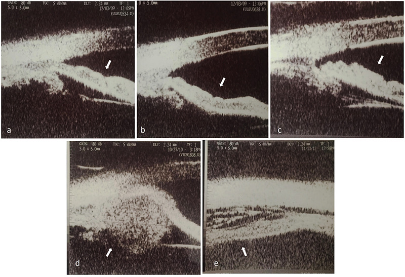 The Diagnostic Value of Ultrasound Biomicroscopy in Anterior Segment Diseases.