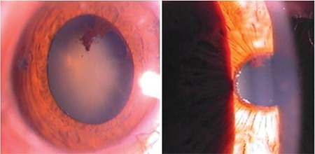 Pseudoexfoliation Glaucoma: Clinical Presentation and Therapeutic Options.