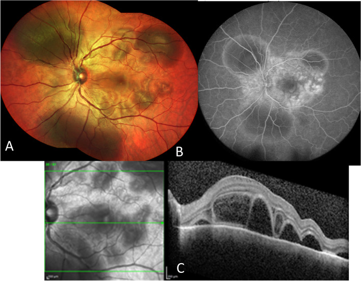 Challenges in posterior uveitis-tips and tricks for the retina specialist.