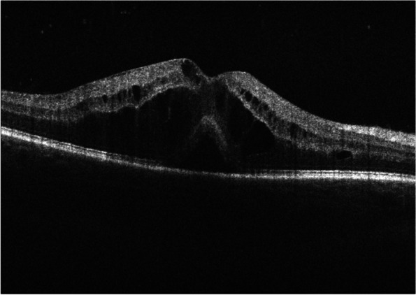 Challenges in posterior uveitis-tips and tricks for the retina specialist.