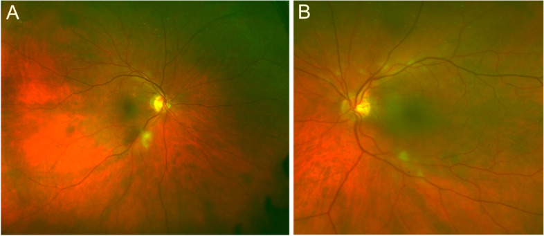 Challenges in posterior uveitis-tips and tricks for the retina specialist.