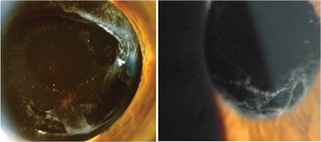 Pseudoexfoliation Glaucoma: Clinical Presentation and Therapeutic Options.