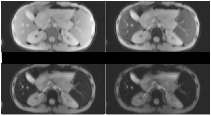 Concomitant Presence of Hb Agrinio and - -Med Deletion in a Greek Male Patient with Hemoglobinopathy H: More Severe Phenotype and Literature Review.