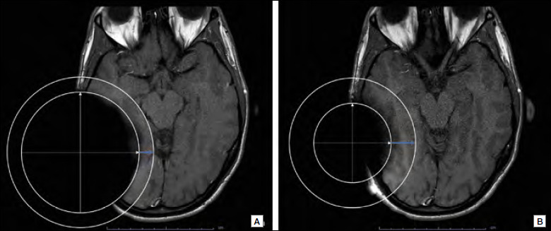 The usefulness of the O-MAR algorithm in MRI skull base assessment to manage cochlear implant-related artifacts.