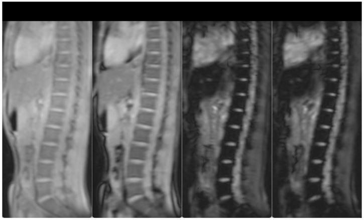 Concomitant Presence of Hb Agrinio and - -Med Deletion in a Greek Male Patient with Hemoglobinopathy H: More Severe Phenotype and Literature Review.