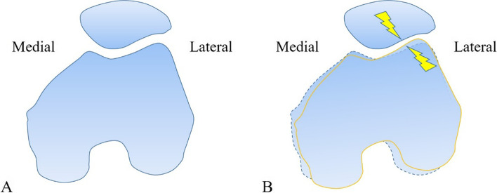 Factors that impact the patellofemoral contact stress in the TKA: a review.