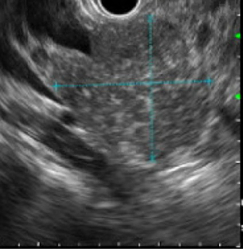 A Diagnostic Conundrum: A Case of Pediatric Autoimmune Pancreatitis.