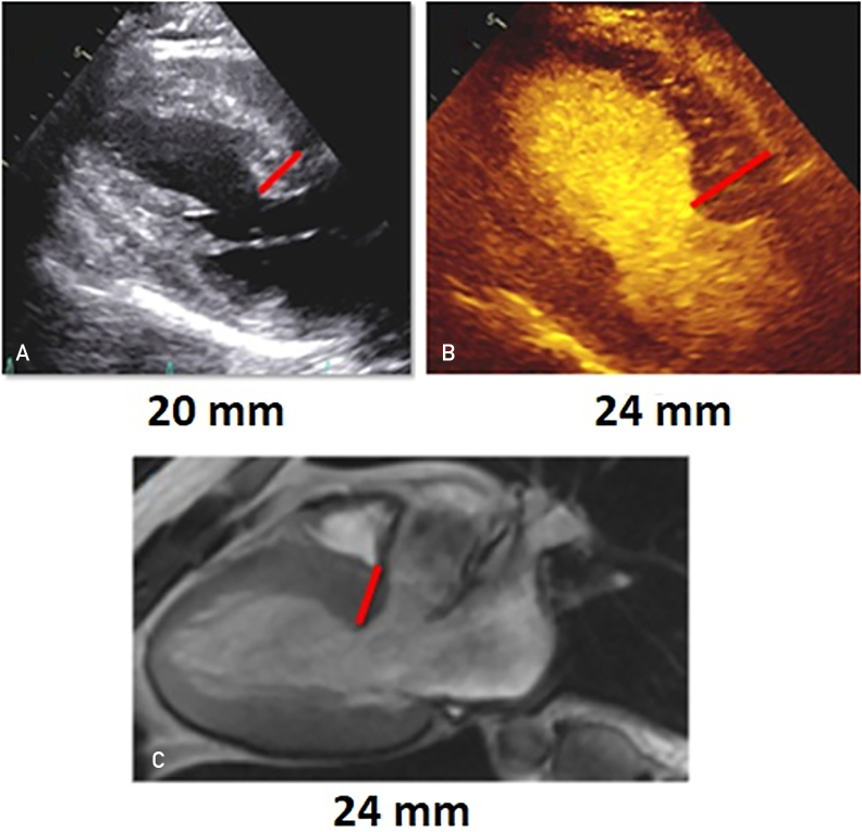 Ultrasound Enhancing Agents with Transthoracic Echocardiography for Maximal Wall Thickness in Hypertrophic Cardiomyopathy