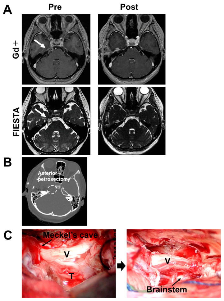 Clinical Effectiveness of Mirogabalin Besylate for Trigeminal Neuropathy after Skull Base Surgery: Illustrative Cases.