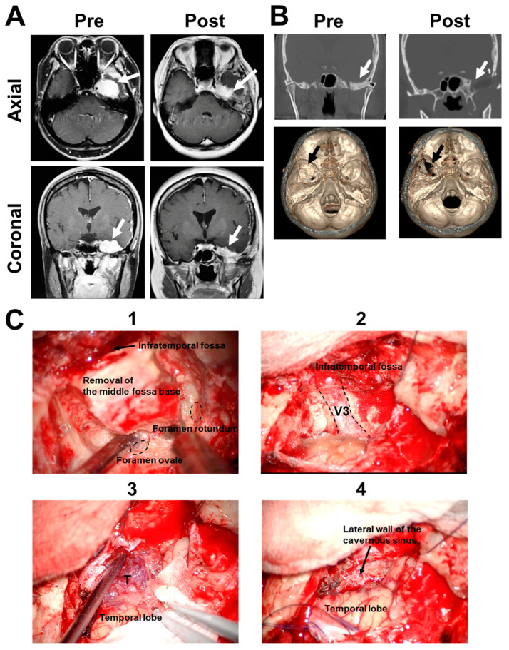 Clinical Effectiveness of Mirogabalin Besylate for Trigeminal Neuropathy after Skull Base Surgery: Illustrative Cases.