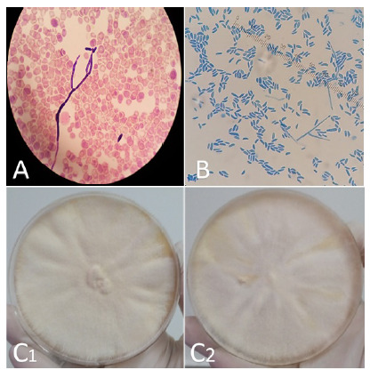 Fusariosis in cancer patients: 13 case series report and literature review