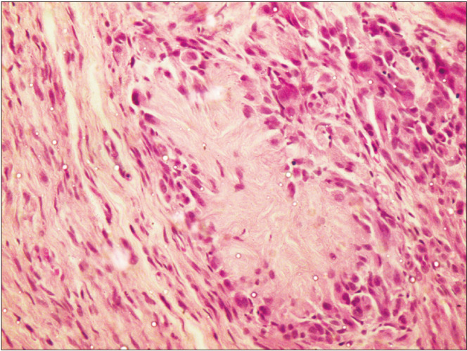 A rare histopathological variant of Schwannoma with rosette-like arrangements and epithelioid cells: a case report from a histopathologist's perspective.