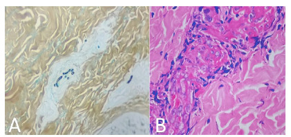 Fusariosis in cancer patients: 13 case series report and literature review