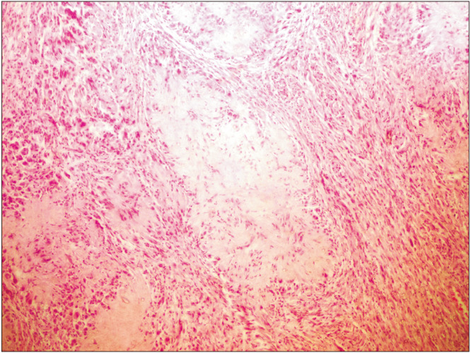 A rare histopathological variant of Schwannoma with rosette-like arrangements and epithelioid cells: a case report from a histopathologist's perspective.