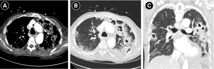 A fatal case report of invasive pulmonary aspergillosis and mucormycosis coinfection in an immunocompetent patient with coronavirus disease 2019 in Korea.