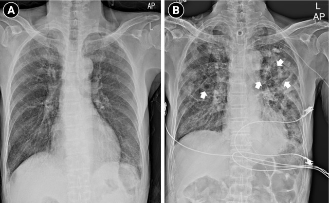 A fatal case report of invasive pulmonary aspergillosis and mucormycosis coinfection in an immunocompetent patient with coronavirus disease 2019 in Korea.