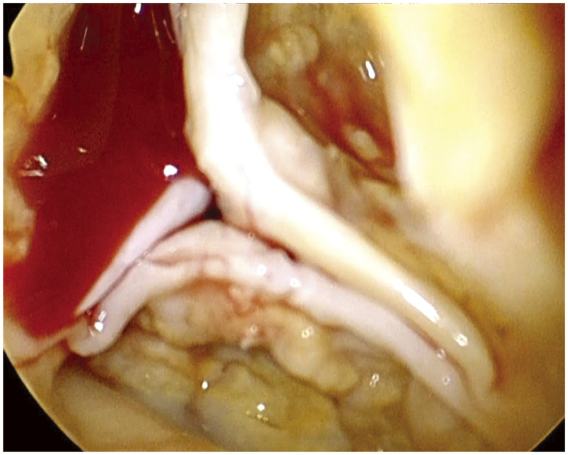 A Patient with Werner's Syndrome Who Underwent Aortic Valve Replacement through Minimally Invasive Cardiac Surgery.