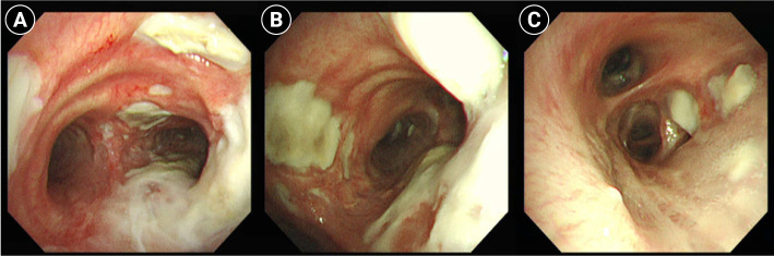 A fatal case report of invasive pulmonary aspergillosis and mucormycosis coinfection in an immunocompetent patient with coronavirus disease 2019 in Korea.