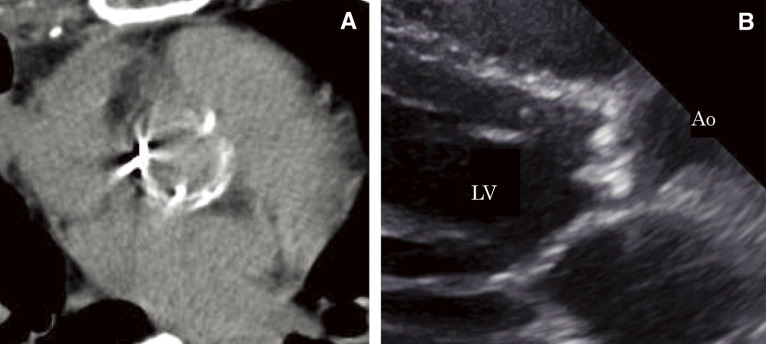 A Patient with Werner's Syndrome Who Underwent Aortic Valve Replacement through Minimally Invasive Cardiac Surgery.