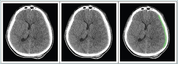 A revolutionary acute subdural hematoma detection based on two-tiered artificial intelligence model.