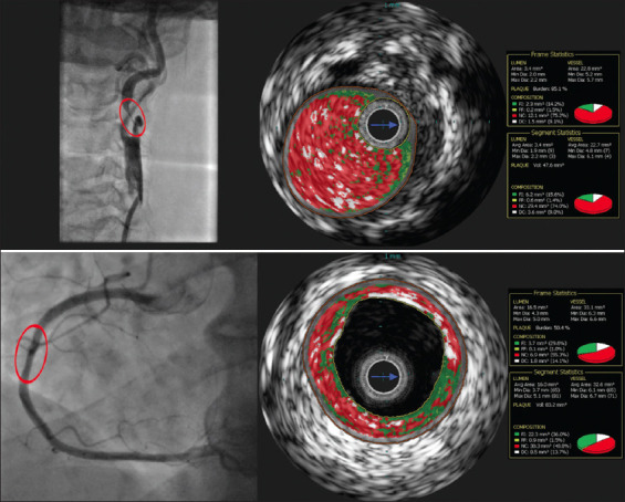 Association between carotid and coronary atherosclerotic plaque morphology: a virtual histology intravascular ultrasound study.