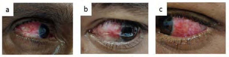 Tofacitinib in Refractory Scleritis: A Case Series.