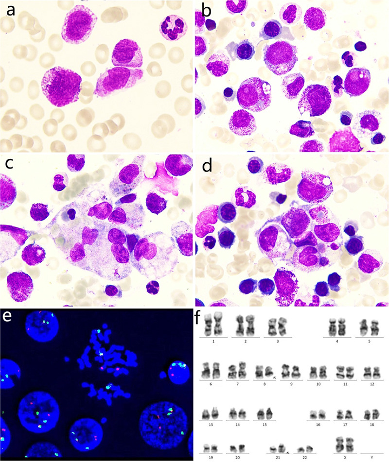 Hemophagocytic Lymphohistiocytosis in <i>RUNX1::RUNX1T1</i> Positive AML with Blast Count Below 20%