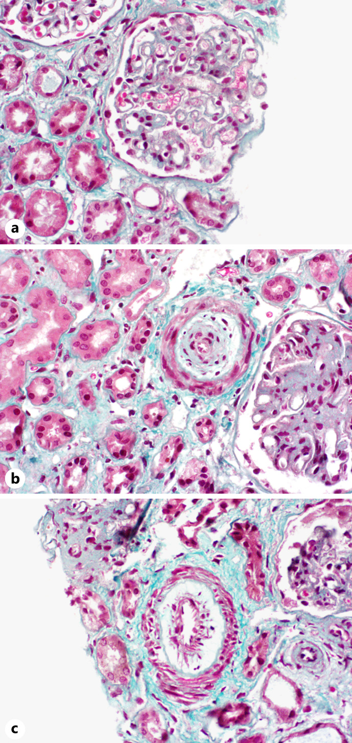 Campylobacter Colitis as a Trigger for Atypical Hemolytic Uremic Syndrome: About One Case.