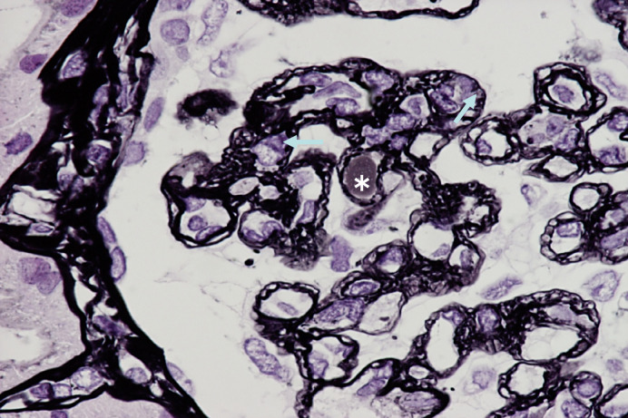 A Case of Mesangial Proliferative Nephritis Caused by Slow Cryoglobulin.