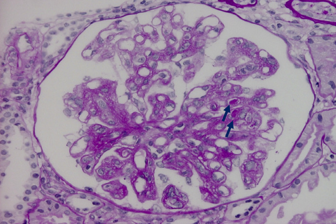 A Case of Mesangial Proliferative Nephritis Caused by Slow Cryoglobulin.