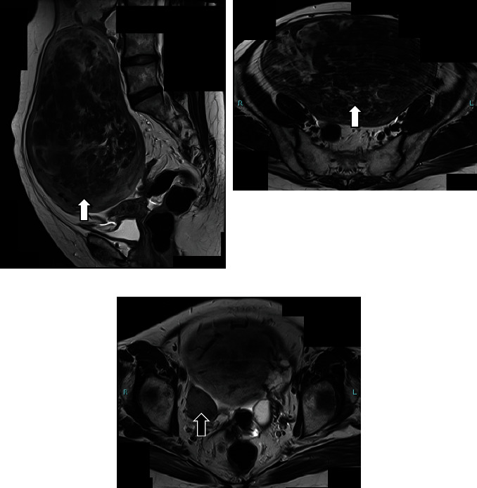 Huge Leiomyomas Arising from Bilateral Uterine Remnants in a Mayer-Rokitansky-Küster-Hauser Syndrome Patient with Coexisting Myotonic Dystrophy Type 1: A Case Report and Literature Review.