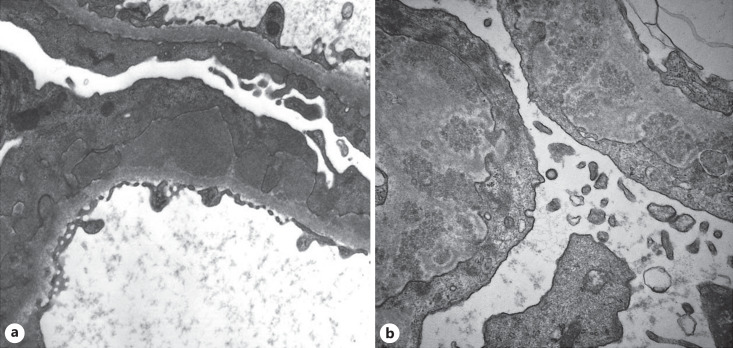 Characterization of Membranous Nephropathy with Microspherular Deposits.