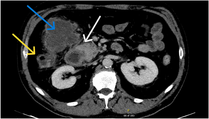 Abscess drain migration into the colon following laparoscopic cholecystectomy