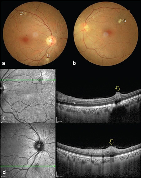 A Case Series of Cat-Scratch Disease with Ocular Manifestations: Clinical Findings and Treatment Approach.