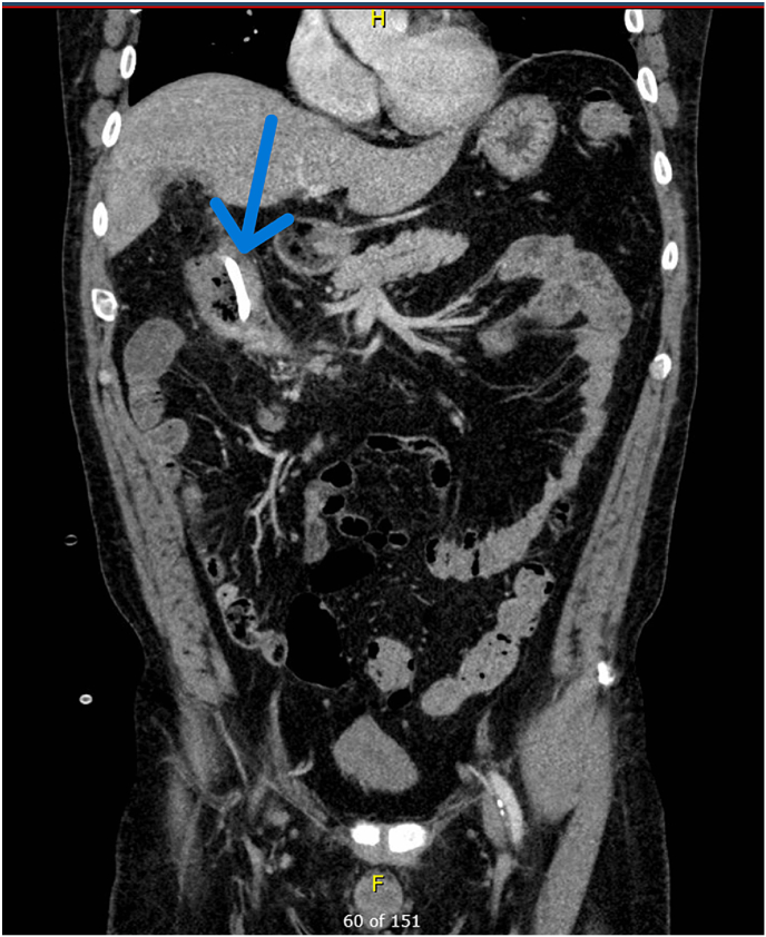 Abscess drain migration into the colon following laparoscopic cholecystectomy