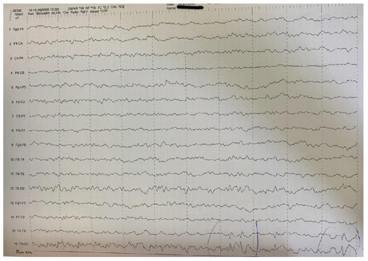 A Case Report of a 5-Year-Old Girl with Self-Limited Epilepsy with Autonomic Seizures.